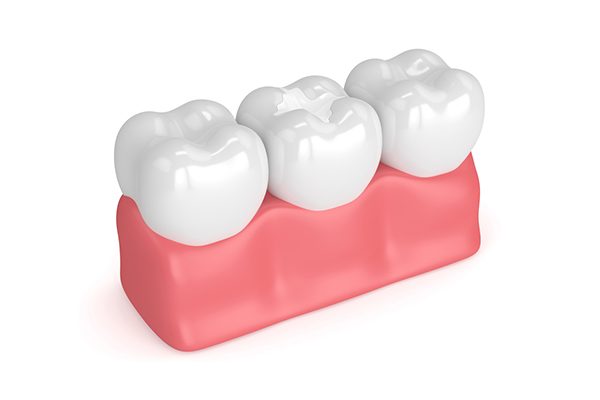 Dental filling (1)