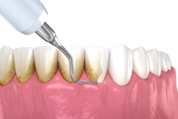 Scaling and polishing